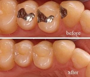 Dental Tooth Filling in Dubai, Abu Dhabi & Sharjah