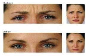 Botox Injection for wrinkles Treatment in Dubai & Abu Dhabi