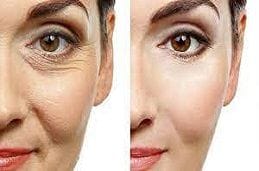 Botox Injection for wrinkles in Dubai & Abu Dhabi