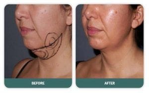 Double Chin Liposuction