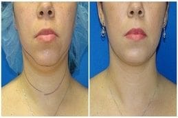 Double Chin Liposuction Clinic in Dubai & Abu Dhabi