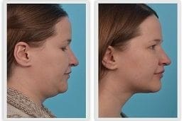 Double Chin Liposuction Treatment Dubai & Abu Dhabi