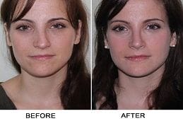 Septoplasty and Turbinate Reduction Clinic in Dubai & Abu Dhabi