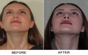 Septoplasty and Turbinate Reduction Treatment Dubai & Abu Dhabi