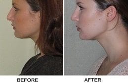 Septoplasty and Turbinate Reduction in Dubai & Abu Dhabi