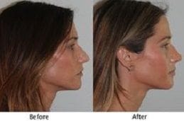 Septoplasty and Turbinate Reduction