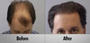 Robotic Hair Transplant in Dubai Sharjah