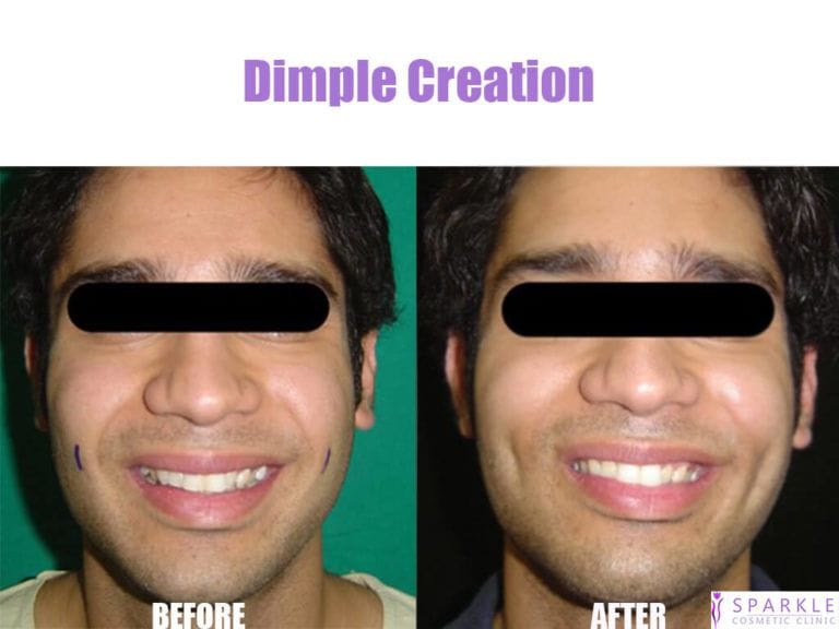 Dimple Creation Surgery in Dubai, Abu Dhabi & Sharjah | Dimpleplasty Cost