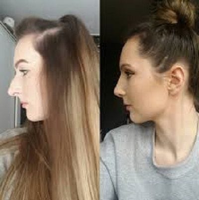 Rhinoplasty Nose Reshaping in Dubai, Abu Dhabi & Sharjah