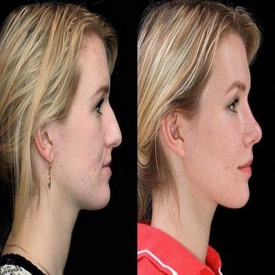 Chin Augmentation in Dubai, Abu Dhabi & Sharjah