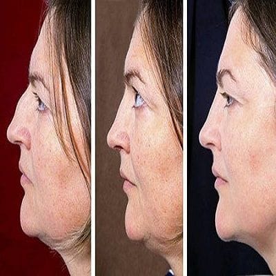Double Chin Removal in Dubai, Abu Dhabi & Sharjah