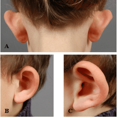 Ear Surgery or Otoplasty in Dubai Abu Dhabi & Sharjah