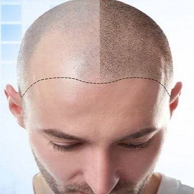 FUT Hair Transplant in Dubai & Abu Dhabi