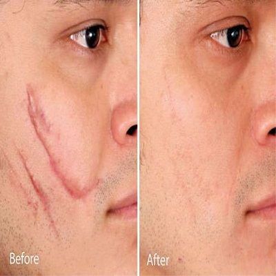 Facial Scar Revision in Dubai