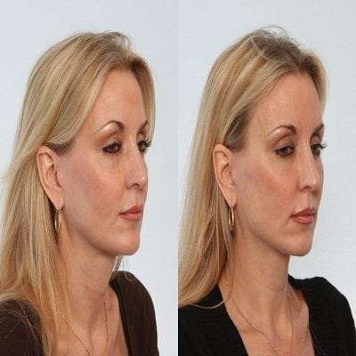 Neck Lift Surgery in Dubai, Abu Dhabi & Sharjah