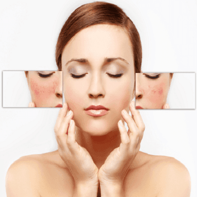 Pigmentation Treatment in Dubai, Abu Dhabi & Sharjah