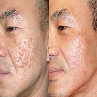 Surgical Scar Revision in Dubai, Abu Dhabi & Sharjah
