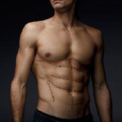 Pectoral implants in Dubai, Abu Dhabi - Chest Implants Dubai For Men