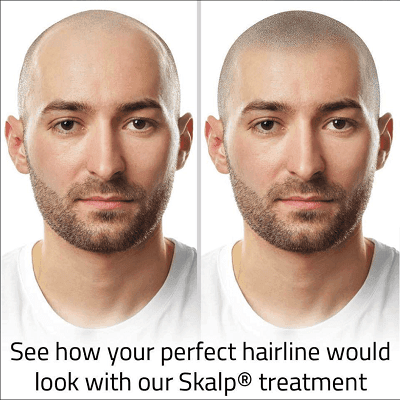 Scalp Micropigmentation in Dubai, Abu Dhabi & Sharjah