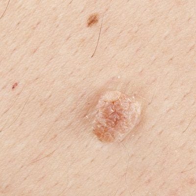 Skin Tags Removal in Dubai, Abu Dhabi & Sharjah