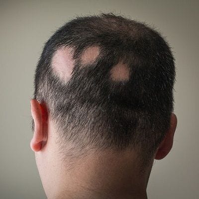 Alopecia Areata Treatment in Dubai, Abu Dhabi & Sharjah