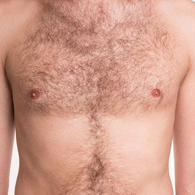 Body Hair Transplant in Dubai & Abu Dhabi