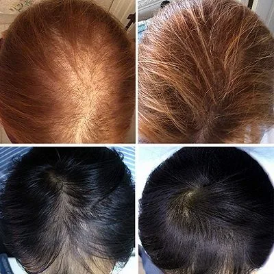 Laser Hair Therapy for Hair Loss in Dubai & Abu Dhabi