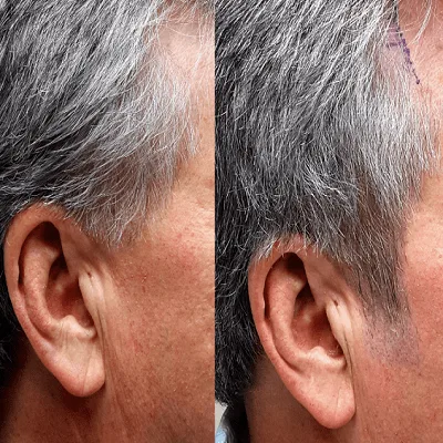 Sideburn Hair Transplant in Dubai & Abu Dhabi