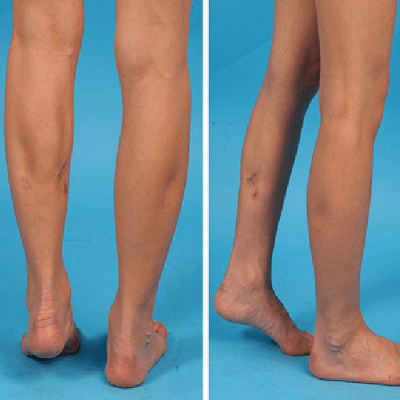 Calf Reduction Surgery in Dubai, Abu Dhabi & Sharjah