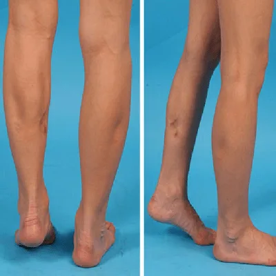 Calf Reduction in Dubai