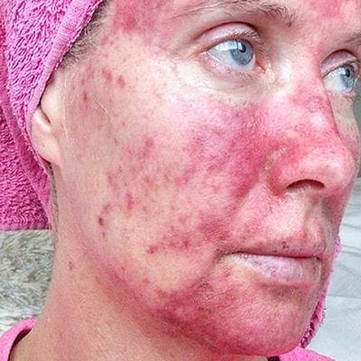 Actinic Keratosis Treatment in Dubai