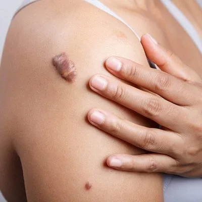 Keloid Treatment in Dubai