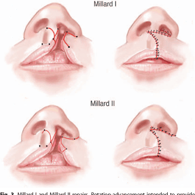 Cleft Lip Surgery in Dubai