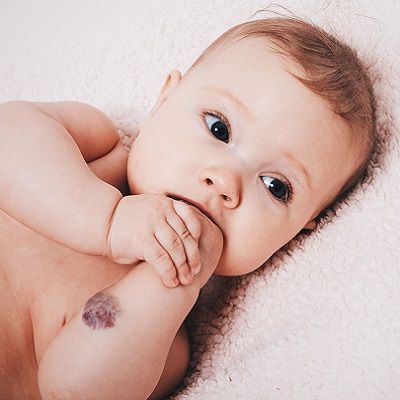 How to Cure Different Types of Hemangiomas?