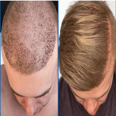 How to Increase Hair Growth Rate After a Hair Transplant