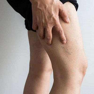 Important Facts About Varicose Veins You Should Know