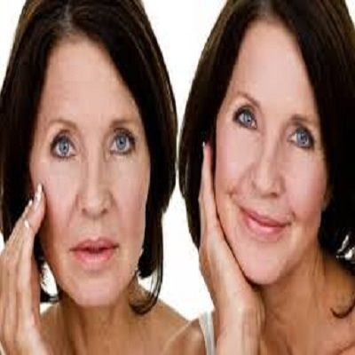 benefits of facelift without surgery