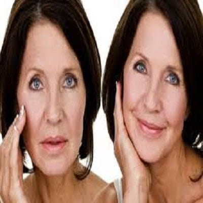 Benefits of Facelift without Surgery