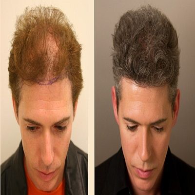 How to get satisfactory hair transplant results