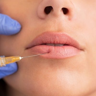 Lip Fillers Injections in Dubai, Abu Dhabi & Sharjah