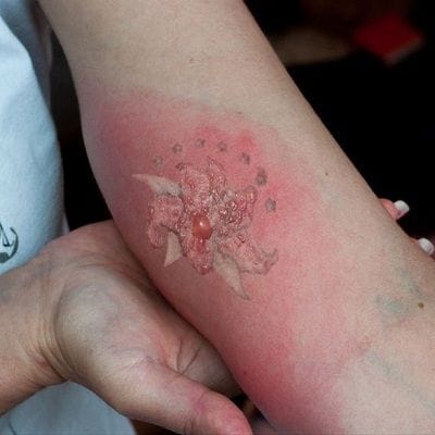 Signs of Infection After Laser Tattoo Removal