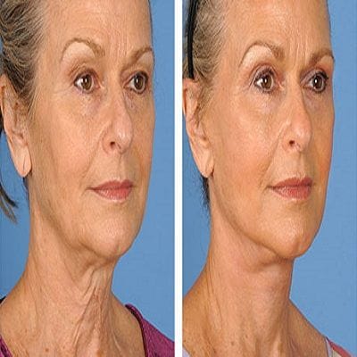 5 Useful Tips to Select a Real or Mini facelift