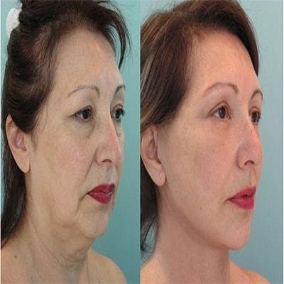 Helpful Skin Care Tips After Facelift Surgery