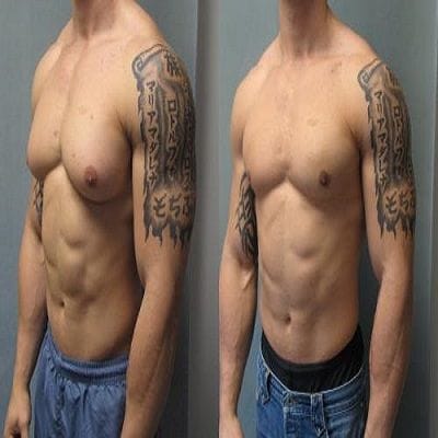 How much does gynecomastia surgery cost Find out here!