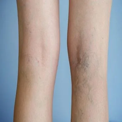 How Can You Get Rid of Varicose Veins and Spider Veins