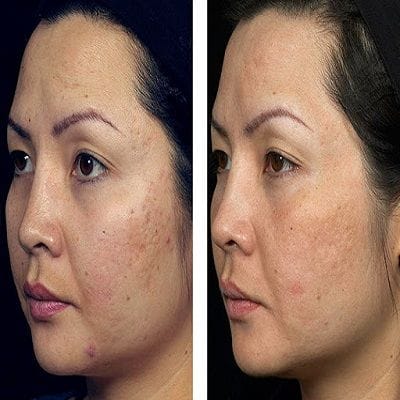 Rejuvenate your Skin through Fractional CO2 Treatment