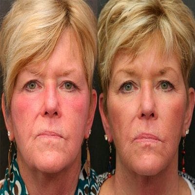 What is the Best Time of Year to Get a Facelift