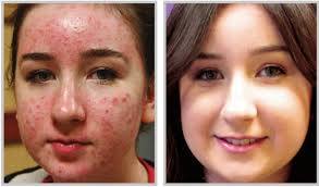 Acne Treatment Before and After in Dubai & Abu Dhabi