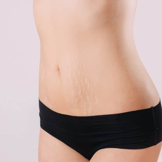 Dermapen Treatment for Old Stretch Marks