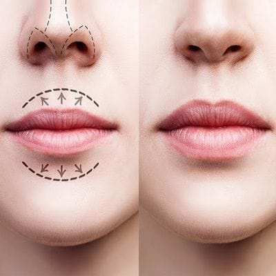 How Much Lip Augmentation Cost in Dubai & Abu Dhabi